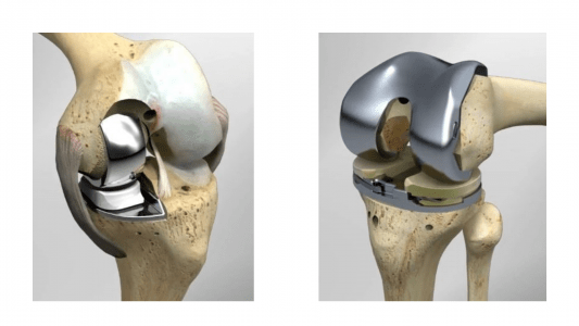 Αντικατάσταση μόνον του φθαρμένου τμήματος της άρθρωσης, με διατήρηση του υπόλοιπου υγιούς τμήματος με τους χιαστούς συνδέσμους (αριστερά). Αντικατάσταση όλης της άρθρωσης στην ολική αρθροπλαστικη (δεξιά).