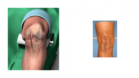 Περιορισμένης έκτασης τομή και προσπέλαση (αριστερά), σε σχέση με την ολική αρθροπλαστική (δεξιά).