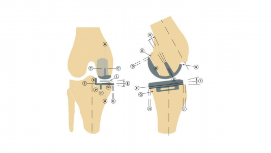 Εικόνα 5: Πολλαπλά σημεία ελέγχου για την άρτια τοποθέτηση της διαμερισματικής αρθροπλαστικής, σύμφωνα με την τεχνική που χρησιμοποιούμε.