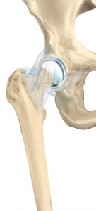 Ολική Αρθροπλαστική Ισχίου με τη μέθοδο SuperPATH