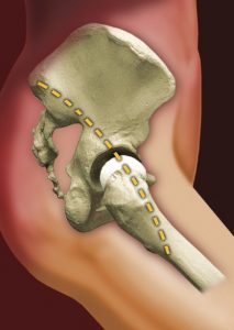 Ολική Αρθροπλαστική Ισχίου με τη μέθοδο SuperPATH