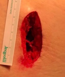 Ολική Αρθροπλαστική Ισχίου με τη μέθοδο SuperPATH