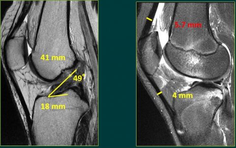 Εικόνα 3: Εξατομικευμένη γωνία κατασκευής των tunnels του μοσχεύματος, ανάλογα με την μοναδική ανατομική του ασθενούς και όχι με βάση τους οδηγούς τοποθέτησης (Εικόνα 3)