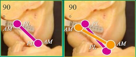 Εικόνα 1: Αριστερά: αποκατάσταση μίας δεσμίδας του πρόσθιου χιαστού. Δεξιά: αποκατάσταση δύο δεσμίδων του πρόσθιου χιαστού, όπως προτείνεται από το Κέντρο μας