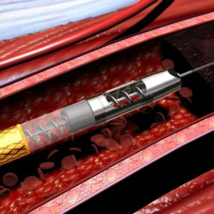 Αναρρόφηση του θρόμβου