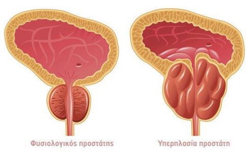 Γραμμένος Euromedica Γενική κλινική υπερπλασία