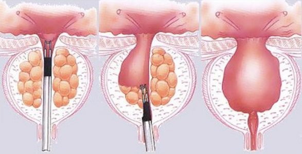 Υπερπλασία προστάτη Γραμμένος Euromedica Γενική κλινική