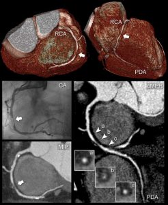 Τρόποι ανάλυσης με την αξονική στεφανιογραφία: A. cMPR (curved multiplanar reconstruction) πάνω στην οποία βασίζεται η διάγνωση, B. MIP (maximum intensity projection) με την οποία απεικονίζονται και οι πιο λεπτοί κλάδοι και C. VRD (volume rendering) που είναι η τρισδιάστατη εικόνα. Παράδειγμα σοβαρού βαθμού στένωσης στην περισπωμένη αρτηρία που επιβεβαιώθηκε και με διαδερμική στεφανιογραφία.