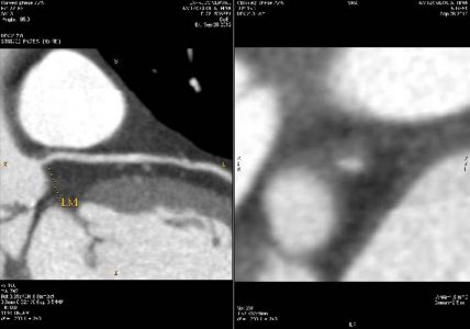 Παράδειγμα μη αποφρακτικής αθηρωματικής πλάκας υψηλού κινδύνου