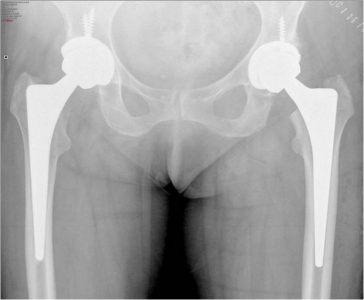 Αμφοτερόπλευρη ολική αρθροπλαστική ισχίου