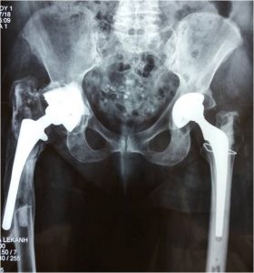 Αναθεώρηση και των δύο ολικών αρθροπλαστικών λόγω  χαλάρωσης  και μετατόπισης της μηριαίας πρόθεσης