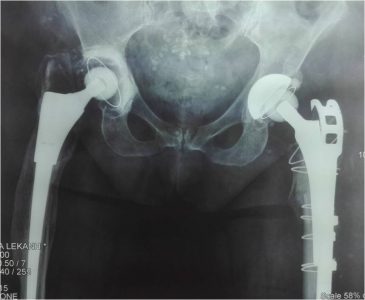 Αναθεώρηση και των δύο ολικών αρθροπλαστικών λόγω καταστροφής του υλικού της κοτύλης