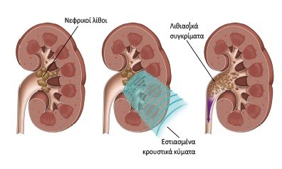 εστιασμένα κρουστικά κύματα σπάζουν τους λίθους σε συγκρίματα