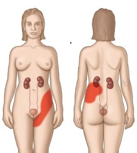 περιοχή πιθανού πόνου κωλικού νεφρού