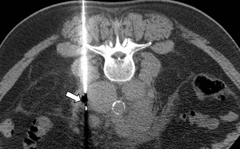 Διαδερμικά κατευθυνόμενη βιοψία παρα-αορτικού λεμφαδένα σε λέμφωμα Hodgkin