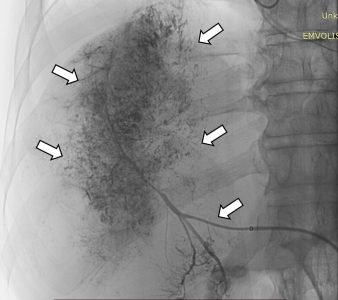 Υπερεκλεκτικός χημειοεμβολισμός πολυεστιακού ηπατοκυτταρικού καρκινώματος