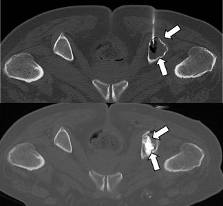 Διαδερμικά κατευθυνόμενη θεραπεία καρκινικού πόνου με οστεκατάλυση και οστεοπλαστική σε ασθενή με οστικές μεταστάσεις λεκάνης από καρκίνο θυρεοειδούς