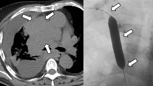 Θεραπεία συνδρόμου άνω κοίλης φλέβας σε ασθενή με εκτεταμένο καρκίνο πνεύμονα