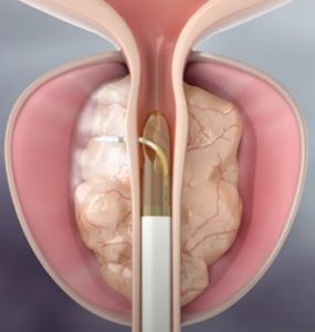 Κατά τη διάρκεια της θεραπείας. Απελευθέρωση ενέργειας υδρατμών εντός 9 δευτερολέπτων στον προστάτη.