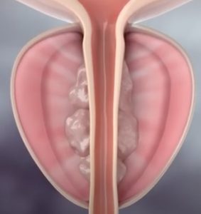 Συρρίκνωση προστάτη 3 μήνες μετά τη θεραπεία