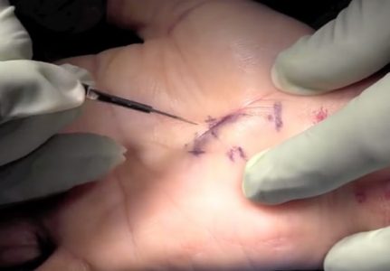 σύνδρομο καρπιαίου σωλήνα 