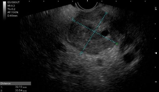 Ενδοσκοπικός υπέρηχος