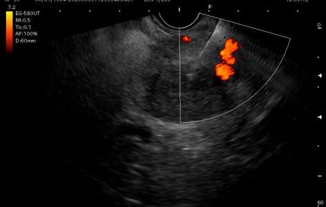 Ενδοσκοπικός υπέρηχος