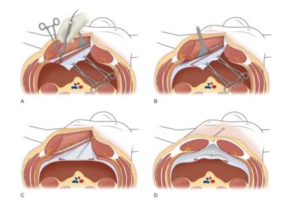 κοιλιοκηλών