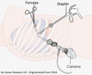 Καρκίνος του πνεύμονα
