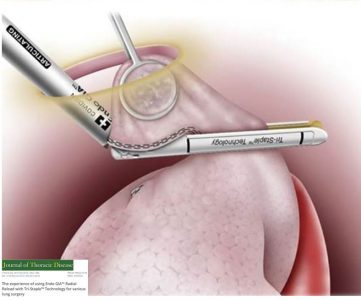 Καρκίνος του πνεύμονα