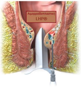 αιμορροϊδοπάθεια