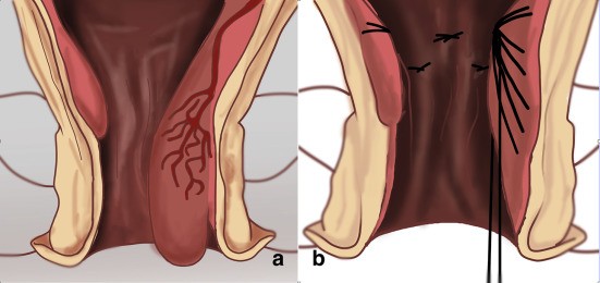 αιμορροϊδοπάθεια