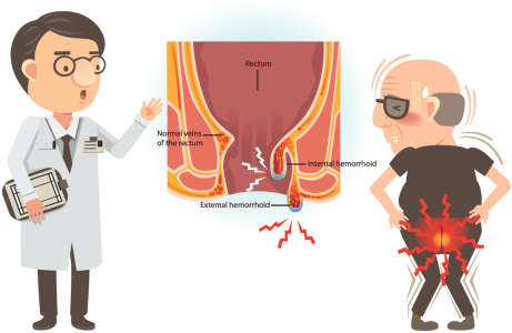 αιμορροϊδοπάθεια