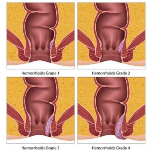 αιμορροϊδοπάθεια