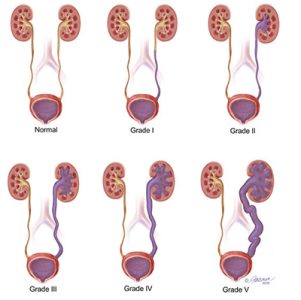 κυστεοουρητηρική 