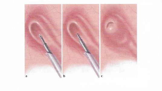 κυστεοουρητηρική 