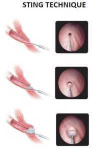 κυστεοουρητηρική 