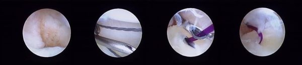 αρθροσκόπηση