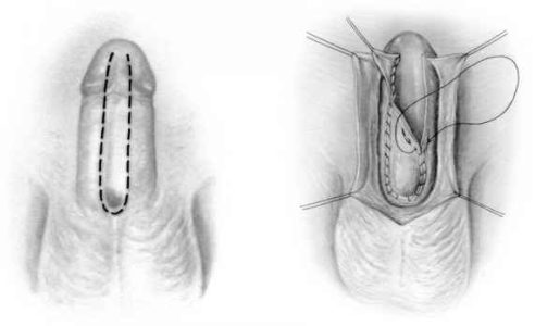 επανορθωτική ανδρολογία