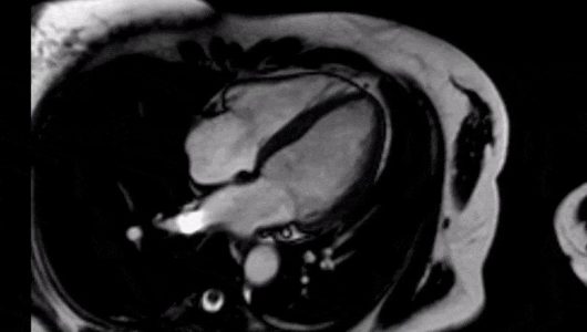 Μαγνητική τομογραφία καρδιάς