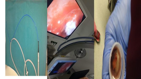 Κρυοβιοψία