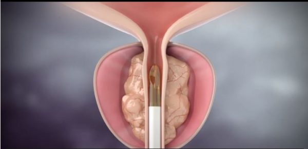 Υπερπλασία