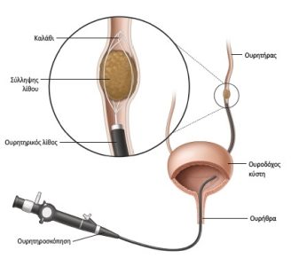 Νεφρολιθίαση