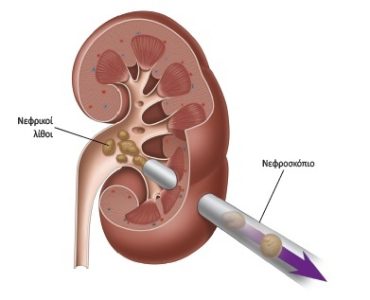 Νεφρολιθίαση