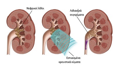 Νεφρολιθίαση