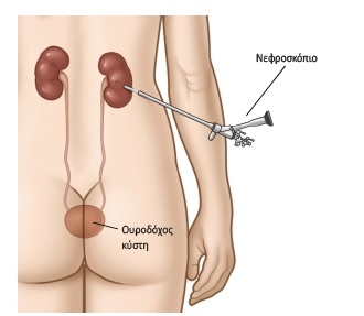 Νεφρολιθίαση