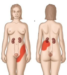 Νεφρολιθίαση