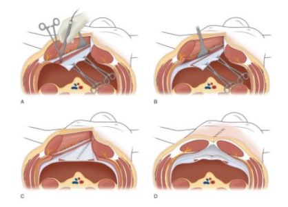Αποκατάσταση
