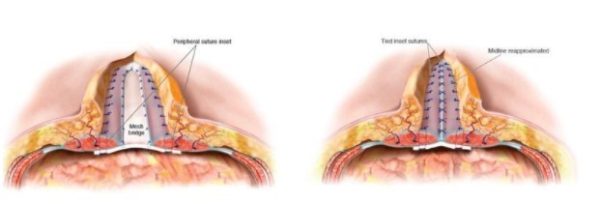 Αποκατάσταση