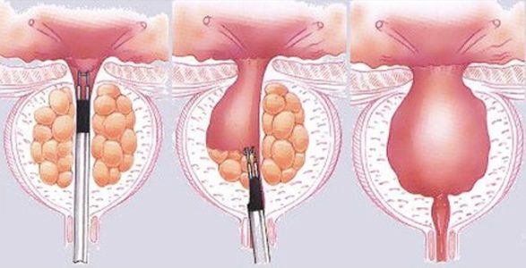 Υπερπλασία